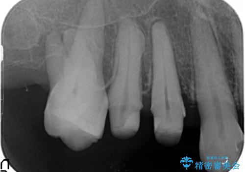 部分矯正を含む 歯周病治療 (再生治療・歯周ポケット除去・MTM・連結補綴)の治療中