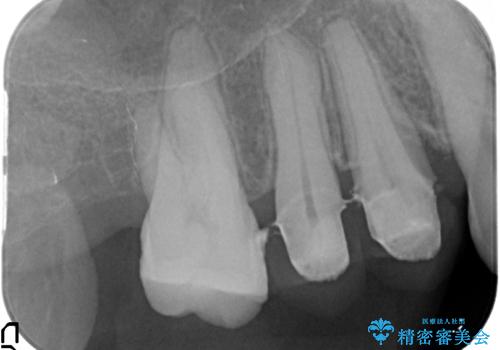 部分矯正を含む 歯周病治療 (再生治療・歯周ポケット除去・MTM・連結補綴)の治療後