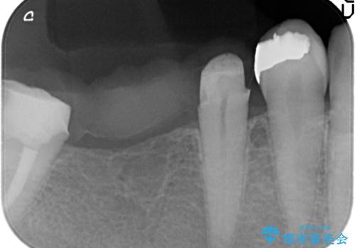 [大臼歯分岐部病変] ブリッジによる咬合機能回復の治療中