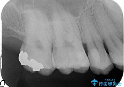 銀歯の劣化・セラミックインレー修復の治療前