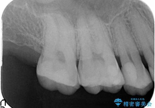 銀歯の劣化・セラミックインレー修復の治療後