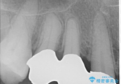 部分矯正を含む 歯周病治療 (再生治療・歯周ポケット除去・MTM・連結補綴)の治療後