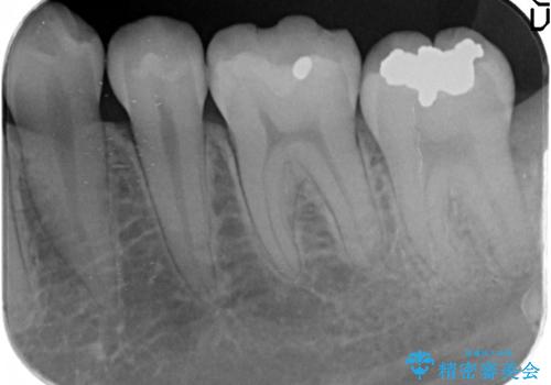 セラミックインレー 古い銀歯の治療の治療前