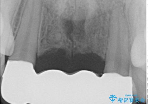 仮歯のまま放置してしまった 審美を改善したいの治療後