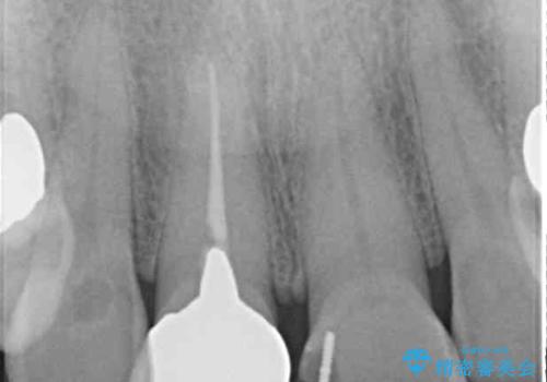 不調和な前歯の審美歯科治療の治療前