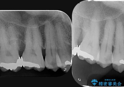 部分矯正を含む 歯周病治療 (再生治療・歯周ポケット除去・MTM・連結補綴)の治療前