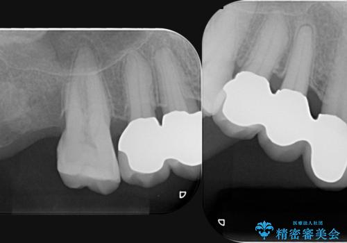 部分矯正を含む 歯周病治療 (再生治療・歯周ポケット除去・MTM・連結補綴)の治療後