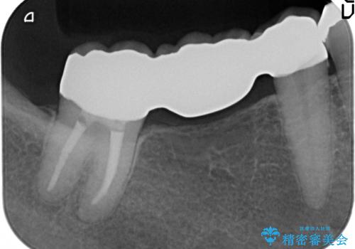 [大臼歯分岐部病変] ブリッジによる咬合機能回復の治療後