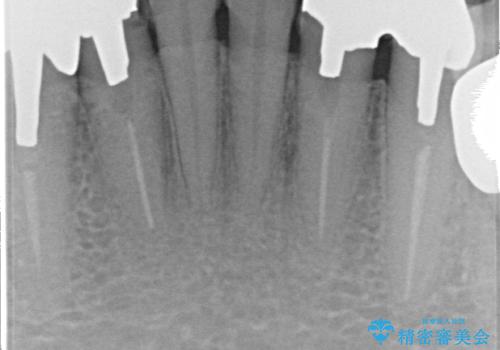 オールセラミッククラウン 前歯部の見た目の改善の治療前