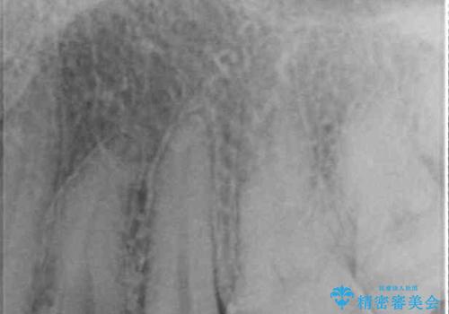 他院で治療中の歯 ゴールドインレーによる修復治療の治療後