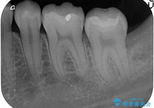 セラミックインレー 古い銀歯の治療の治療後