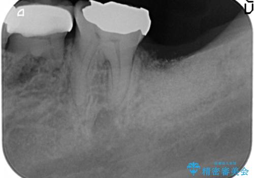 歯の破折による抜歯 インプラントによる咬合機能回復の治療後