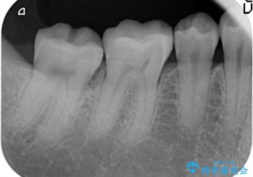 セラミックインレー 銀歯を白くの治療後