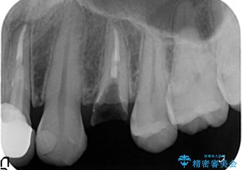 オールセラミッククラウン 歯牙の挺出後の補綴の治療中