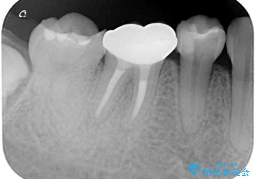 治療の度に痛んだ歯 セラミッククラウンによる補綴治療の治療後