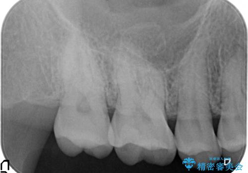 セラミックインレー 古い銀歯のやり替えの治療後