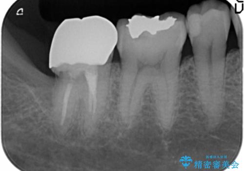 奥歯に違和感がある 30代男性の治療前