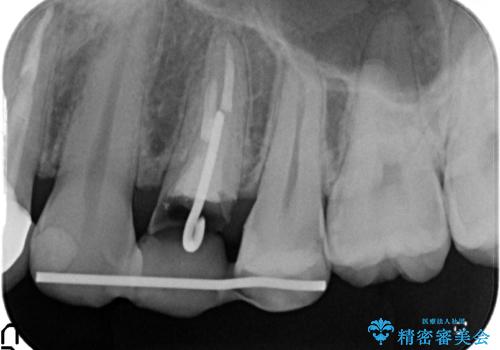 オールセラミッククラウン 歯牙の挺出後の補綴の治療中