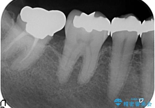 [大臼歯分岐部病変] ブリッジによる咬合機能回復の治療前