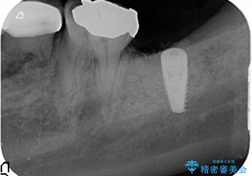 歯の破折による抜歯　インプラントによる咬合機能回復の治療後