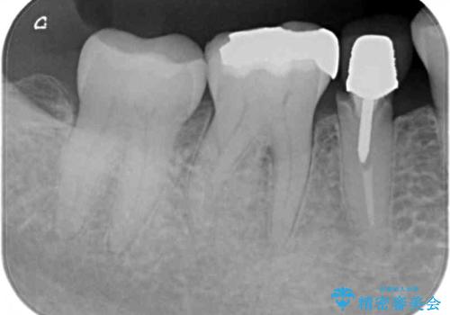 歯に穴があいた　奥歯のセラミック治療の治療前