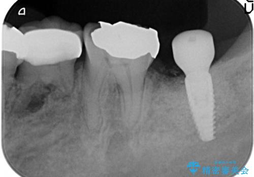 歯の破折による抜歯 インプラントによる咬合機能回復の治療後