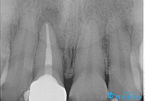 オールセラミッククラウン(スペシャル) 変色が気になる前歯部の補綴の治療後