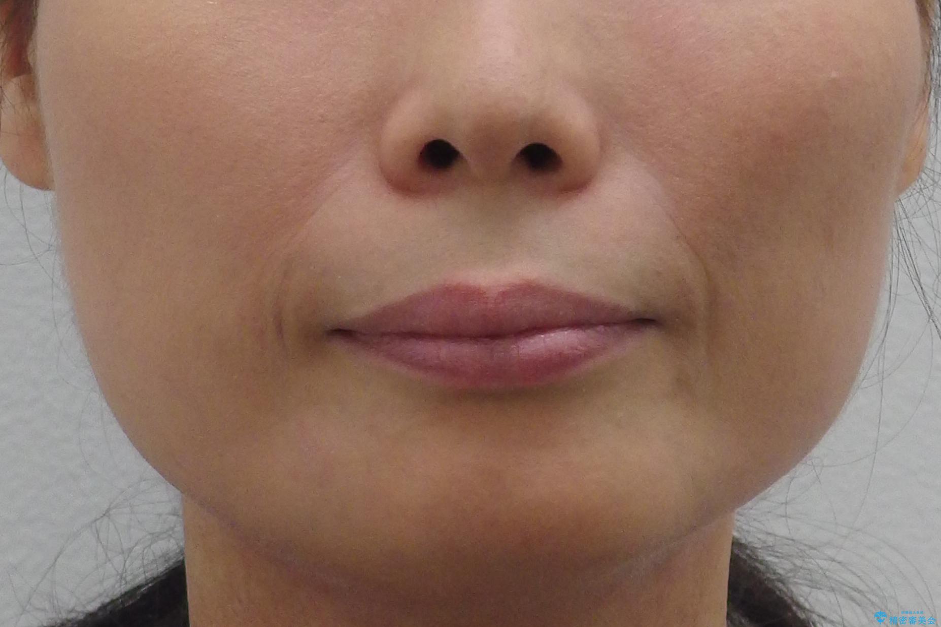 前歯のすきま 右上の小臼歯の垂直的骨吸収を抜歯で解決の治療前(顔貌)