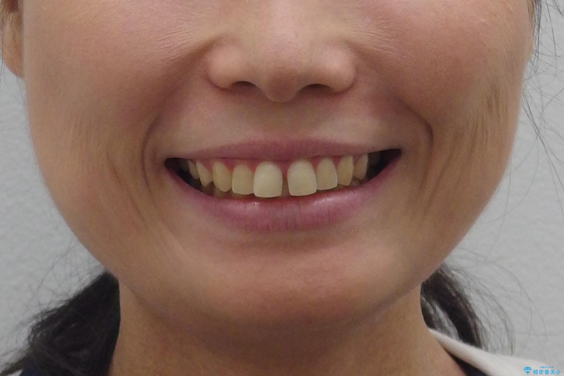 前歯のすきま　右上の小臼歯の垂直的骨吸収を抜歯で解決の治療前（顔貌）