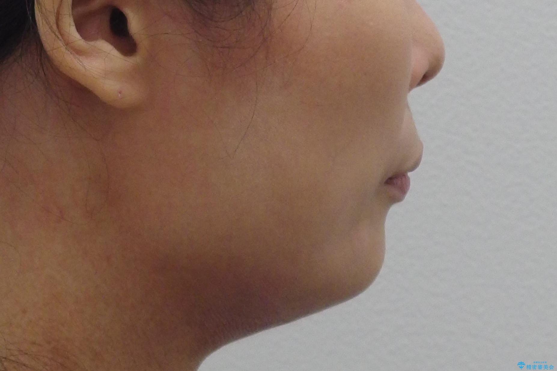 前歯のすきま 右上の小臼歯の垂直的骨吸収を抜歯で解決の治療前(顔貌)