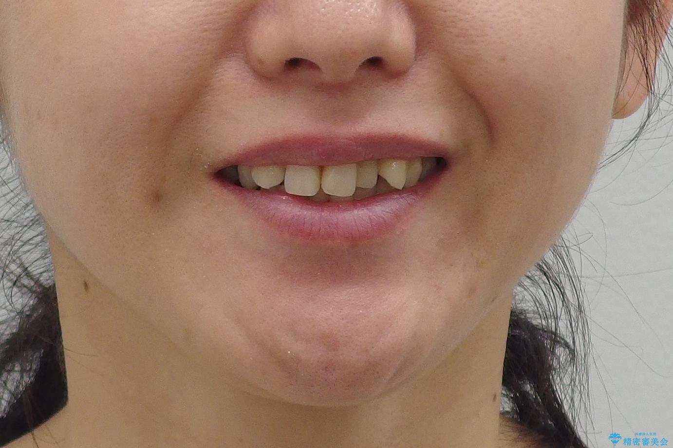 前歯で引っ込んでいる歯がある　他院で矯正200万と言われたの治療前（顔貌）