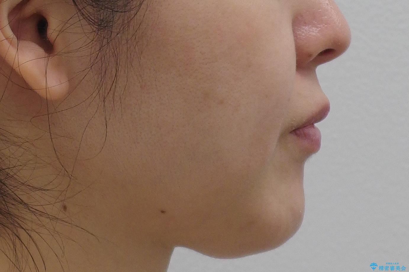 前歯で引っ込んでいる歯がある 他院で矯正200万と言われたの治療前(顔貌)