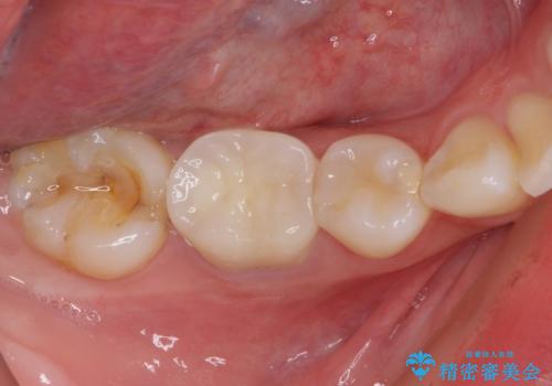 治療の度に痛んだ歯 セラミッククラウンによる補綴治療の治療後