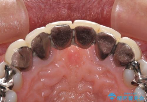 飛行機を利用しての通院 気になる所を全て治療する総合歯科治療の治療前