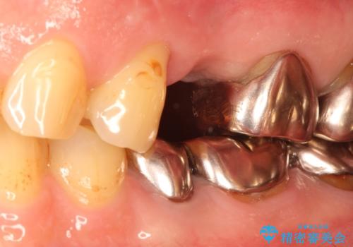 小臼歯部のインプラントの治療中