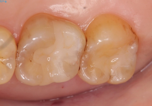 セラミックインレー　古い銀歯のやり替えの治療後
