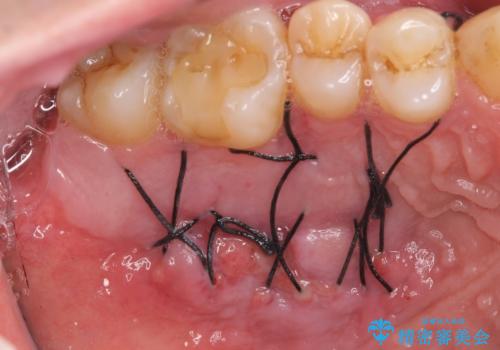 歯肉移植 矯正前の歯肉退縮の改善および予防の治療後