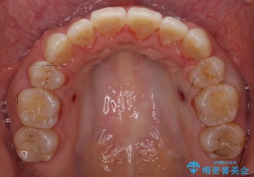 ハーフリンガル　犬歯のねじれ　歯根の外部吸収している歯を抜歯の治療後