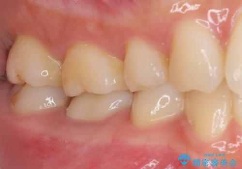 治療の度に痛んだ歯 セラミッククラウンによる補綴治療の治療後
