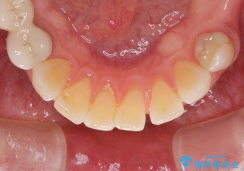 飛行機を利用しての通院 気になる所を全て治療する総合歯科治療の治療前