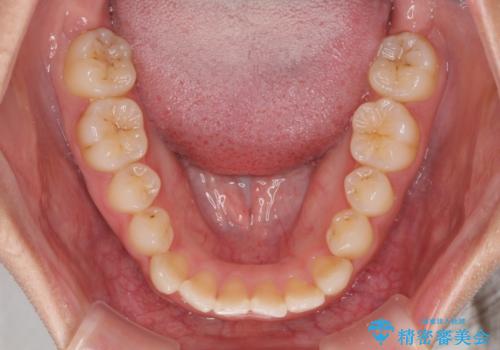 前歯の反対咬合 非抜歯のワイヤー矯正の治療前