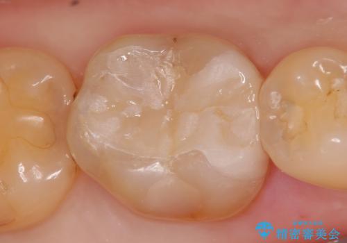 セラミックインレー 銀歯を白くの治療後