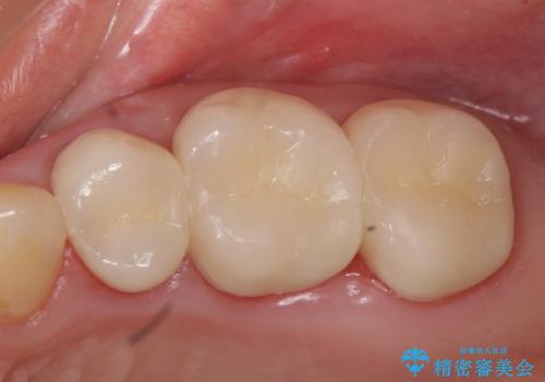 オールセラミッククラウン 根管治療後の補綴