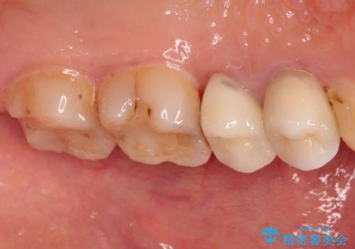 歯肉の中までの深い虫歯　部分矯正後のセラミック治療の治療後