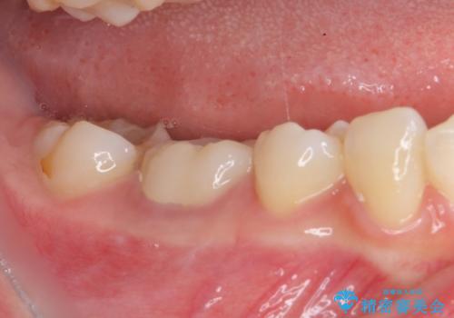 治療の度に痛んだ歯 セラミッククラウンによる補綴治療の治療後