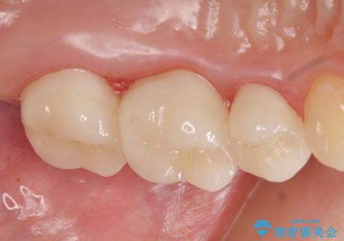 オールセラミッククラウン 根管治療後の補綴の治療後