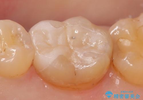 セラミックインレー 銀歯を白く