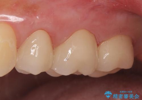 オールセラミッククラウン 根管治療後の補綴の治療後