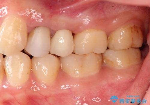 歯肉の中までの深い虫歯 部分矯正後のセラミック治療の治療後