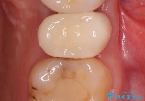 歯肉の中までの深い虫歯 部分矯正後のセラミック治療の治療後